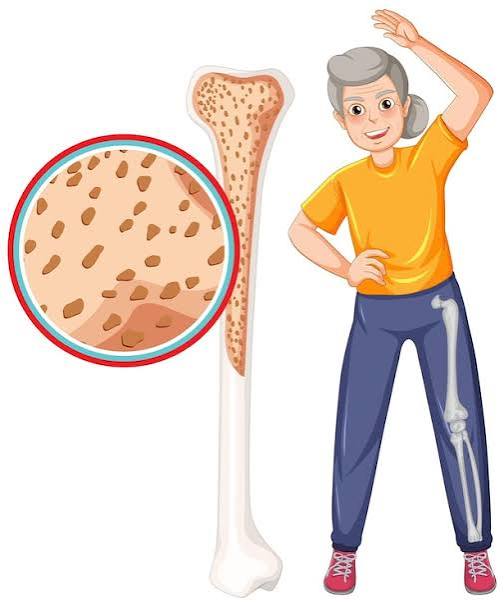 Wat je over osteoporose moet weten